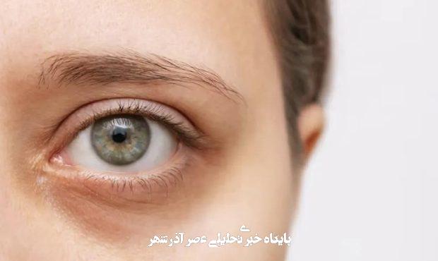 آیا واقعاً شببیداری باعث ایجاد حلقههای تیره زیر چشم میشود؟ آیا واقعاً شببیداری باعث ایجاد حلقههای تیره زیر چشم میشود؟