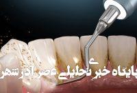 جرم گیری دندان و قیمت آن در سال 1404