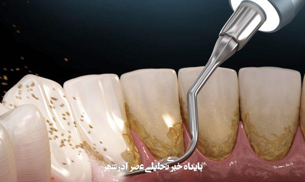 جرم گیری دندان و قیمت آن در سال 1404 جرم گیری دندان و قیمت آن در سال 1404