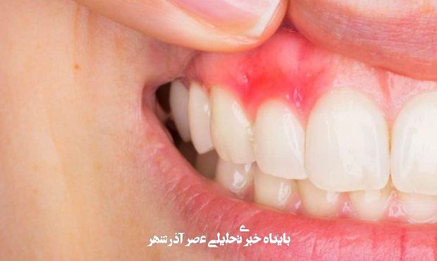 عفونت دندان و مشکلات آن: هر آنچه باید بدانید
